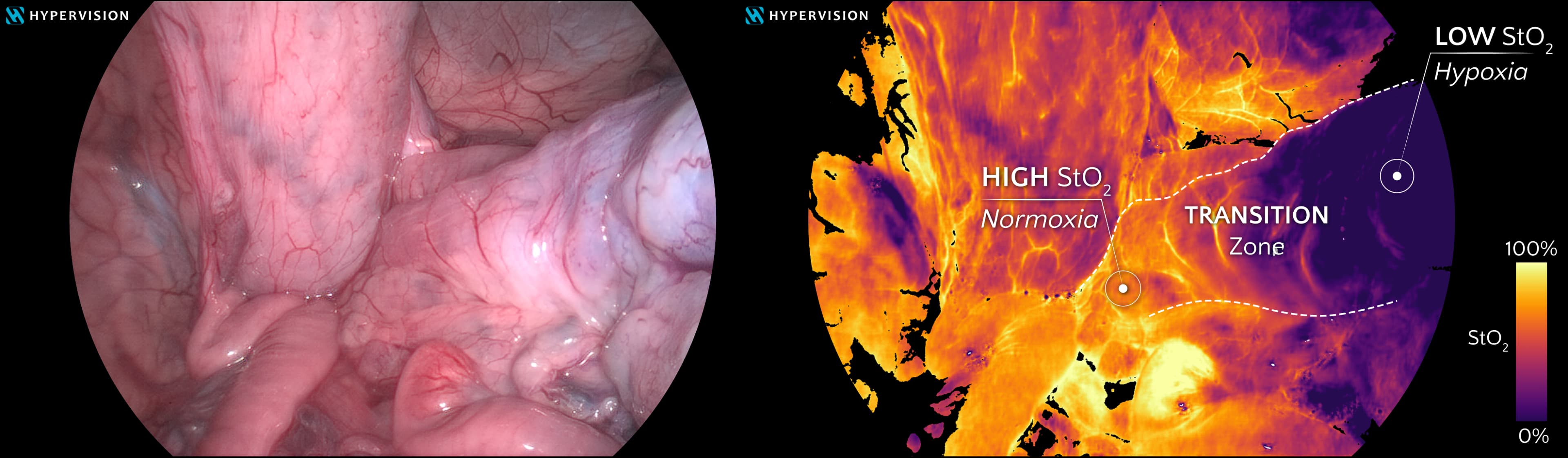 2025-07_fda-510k Side-by-side laparoscopic bowel view and spectral oxygenation map showing high, transition, and low tissue oxygenation.
