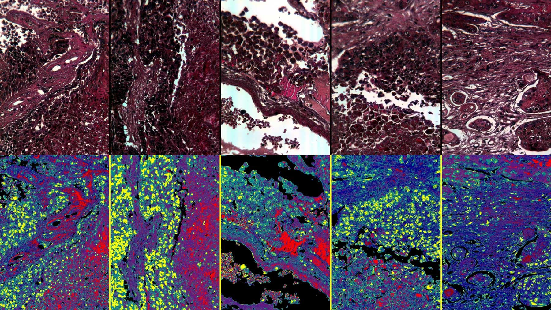 hyperspectral_imaging_digital_pathology_cancer_cells_detection_imec_1 Color and classified tissue maps from hyperspectral data, highlighting lung cancer areas in yellow.