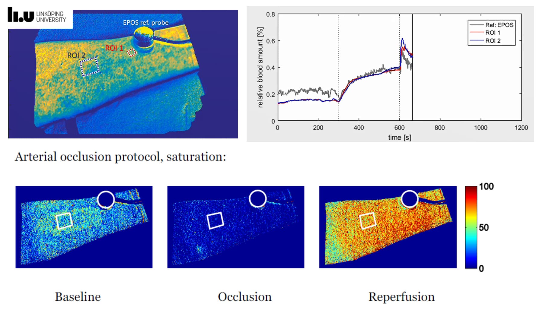 skin_perfusion_oxygenation_snapshot_hyperspectral_Linkoping_1 Hyperspectral skin imaging with a probe and color maps showing blood volume and oxygen saturation over time.