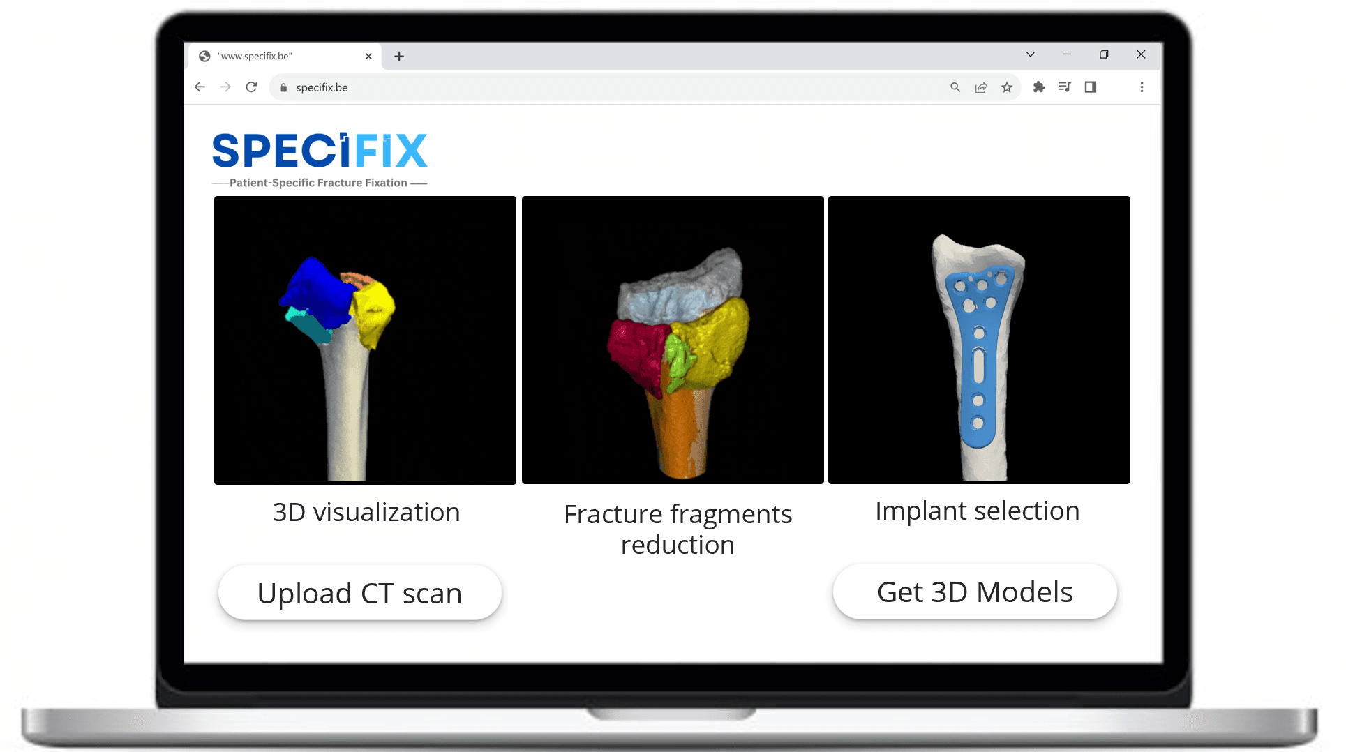 Specifix wrist fracture planning software on laptop screen Laptop screen showing Specifix wrist fracture planning software with 3D bone models and implant selection